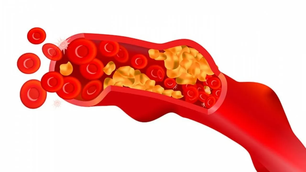 Методы лечения патологии артерий разработали казахстанские ученые