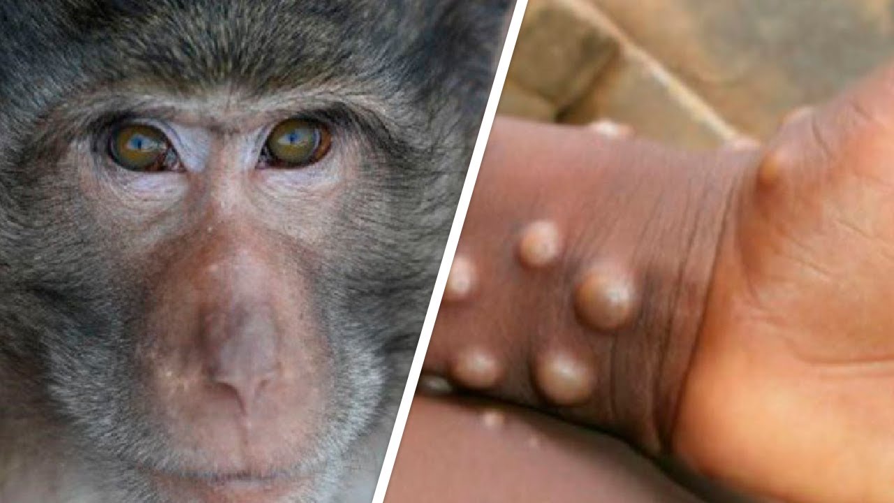США начинают вакцинацию против обезьяньей оспы