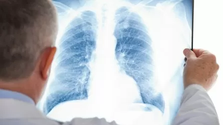 Ученые разработали вещество для лечения тяжелого воспаления легких  