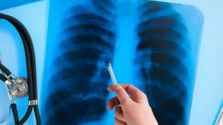 Қазақстанда туберкулезден өлім-жітім көрсеткіші 15 есе төмендеген