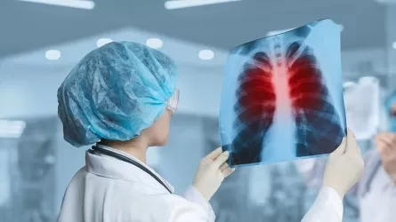 Енді туберкулезді жедел анықтайтын заманауи әдіс қолданылады