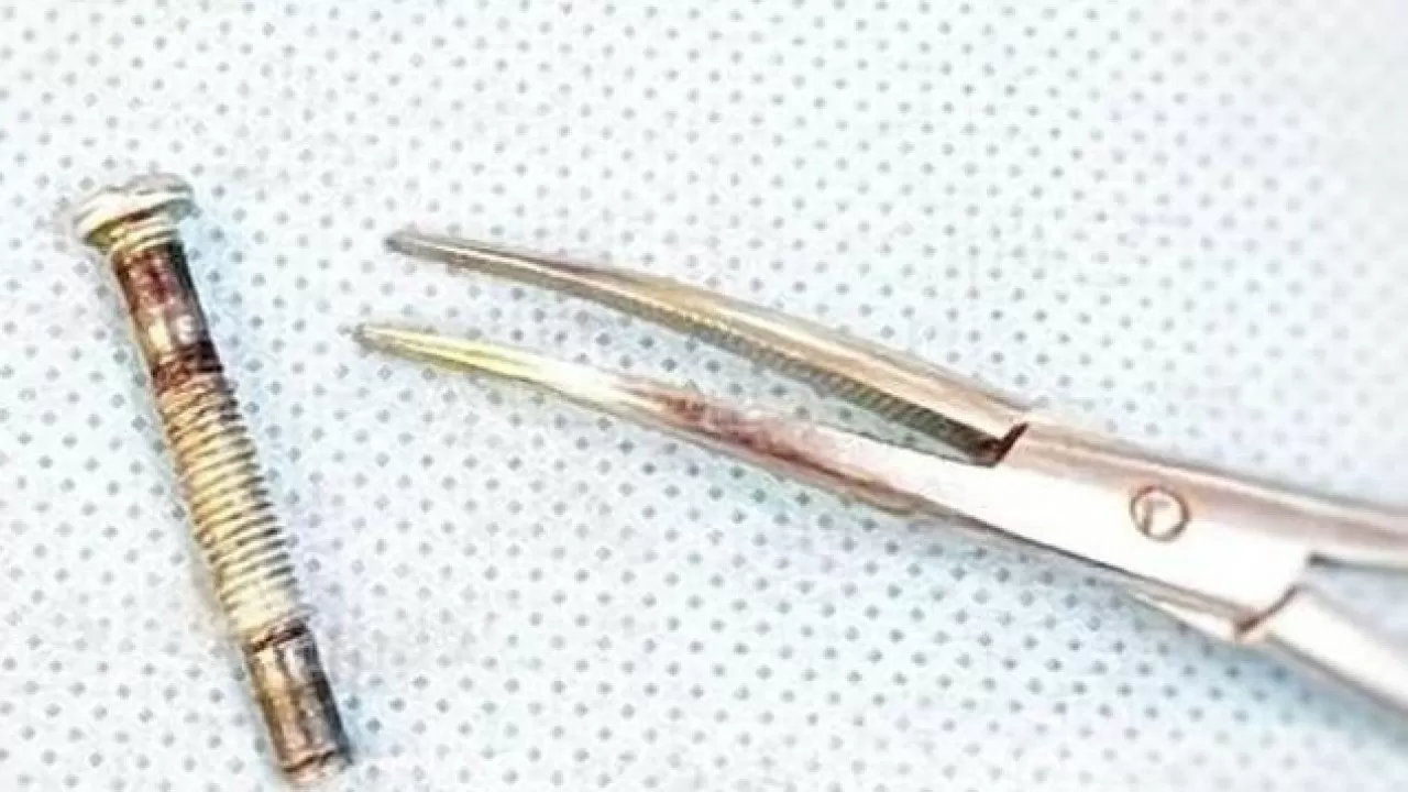 Медики извлекли болт из горла годовалого ребенка в Туркестанской области 