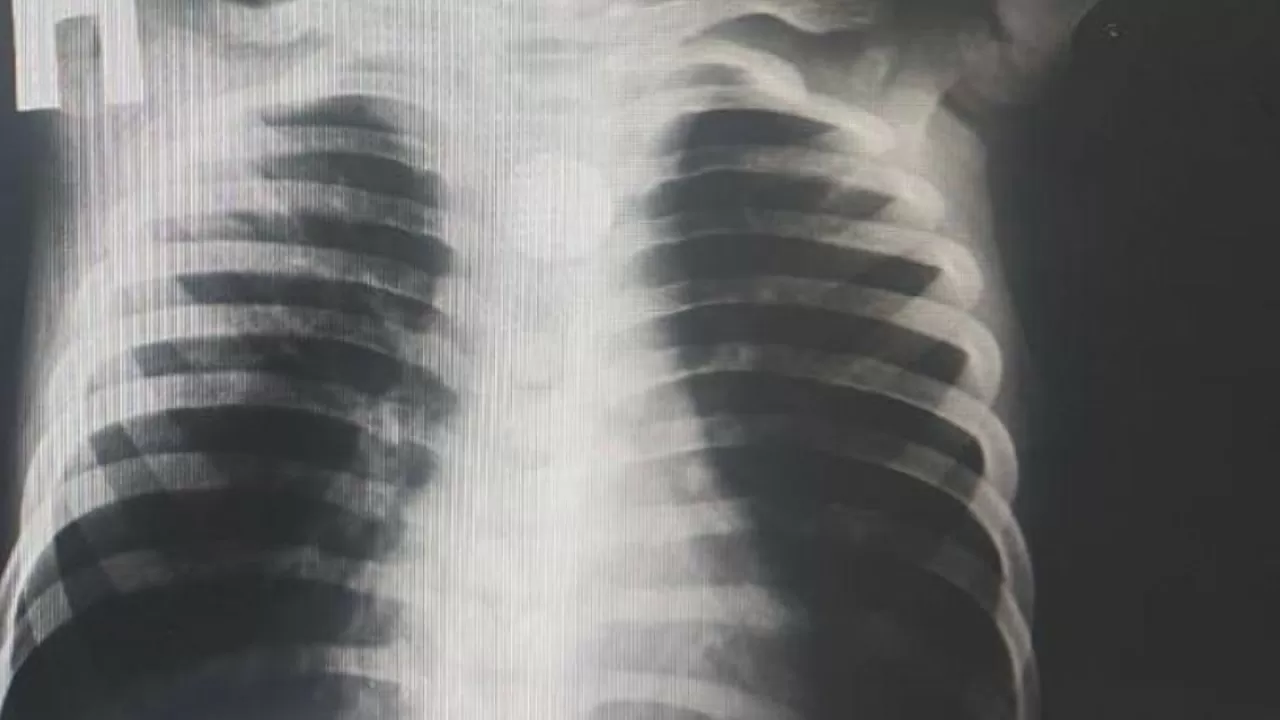 Түркістандық дәрігерлер баланың өңешінен бөгде затты алып шықты