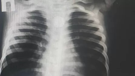 Түркістандық дәрігерлер баланың өңешінен бөгде затты алып шықты