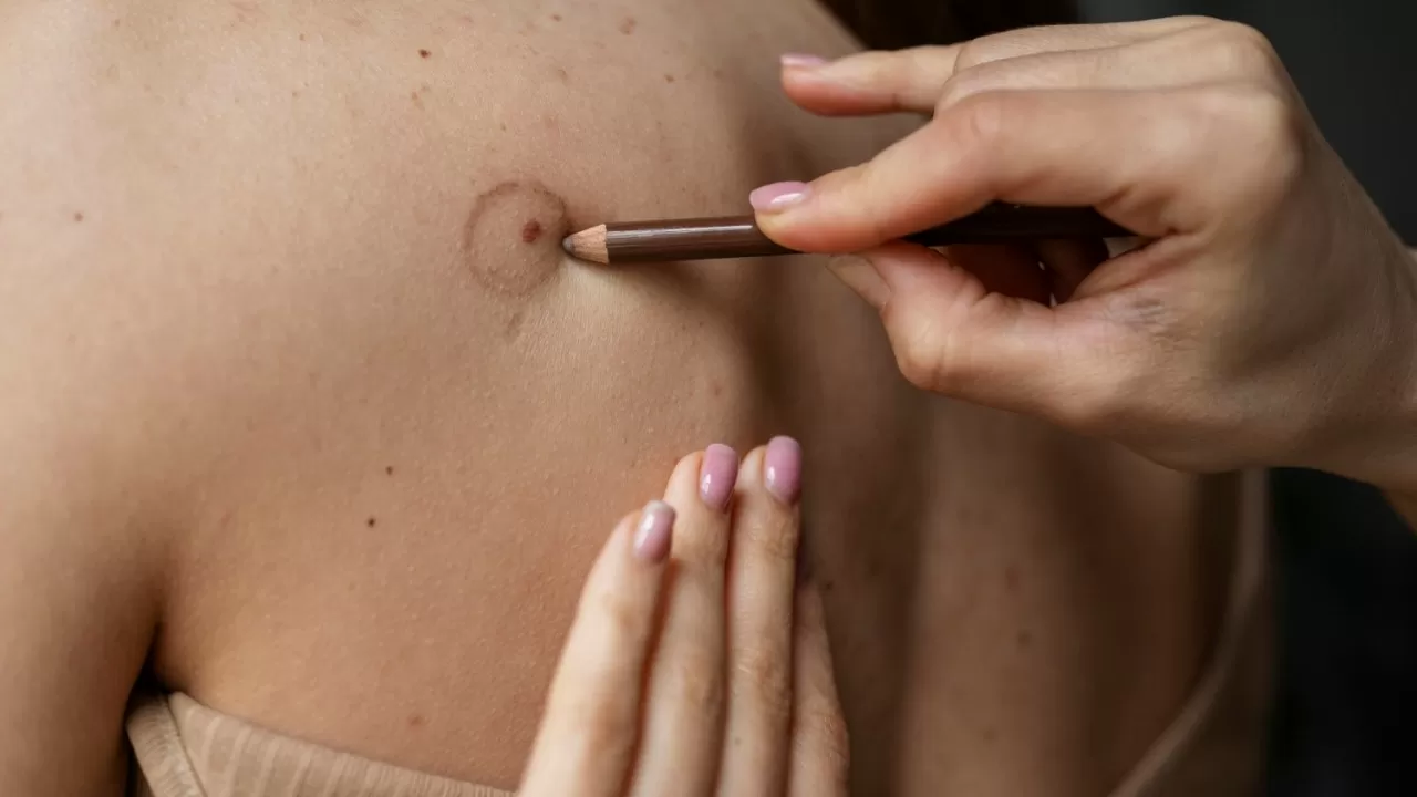 Сигнал на коже: когда родинка может стать смертельной угрозой