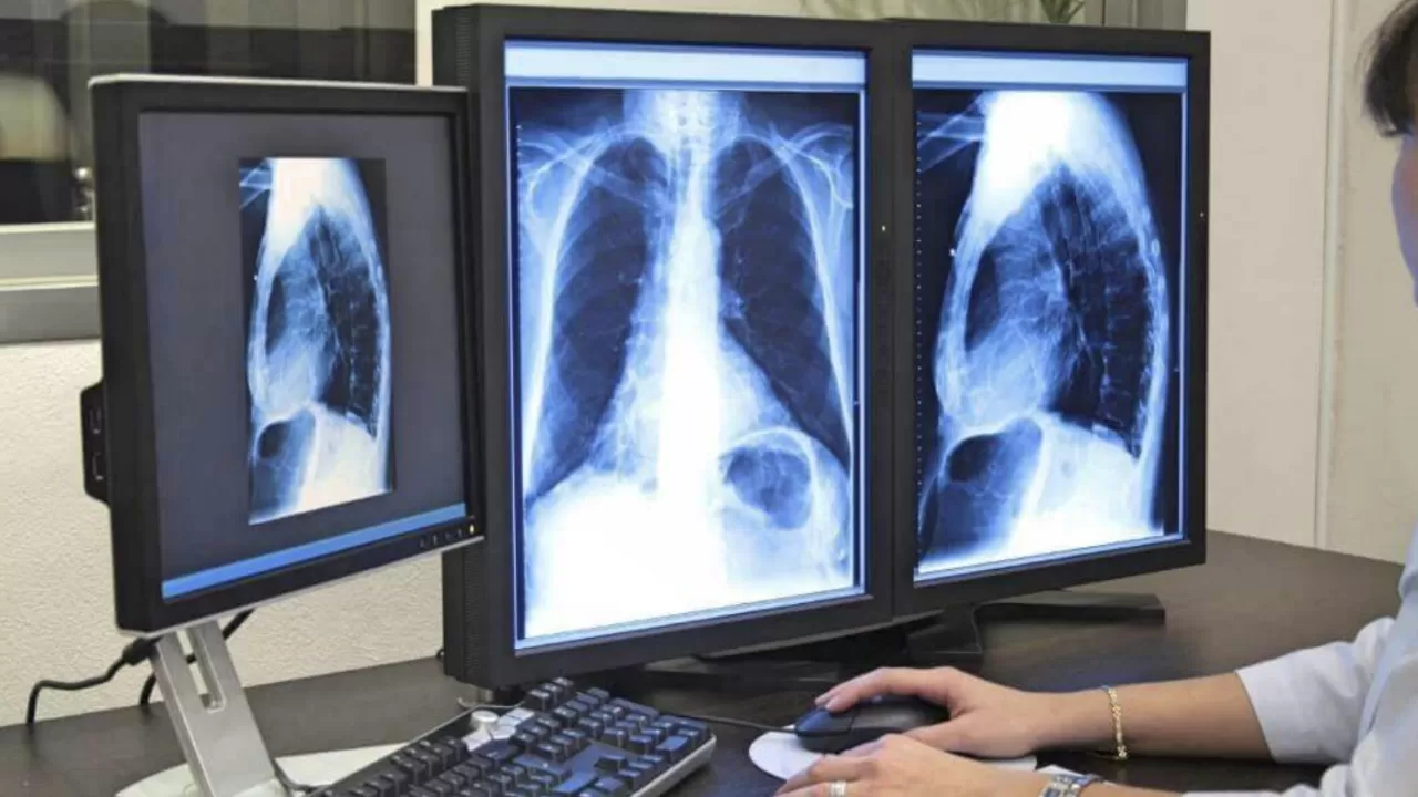 Елде өкпе обырына міндетті скрининг енгізілуі мүмкін   