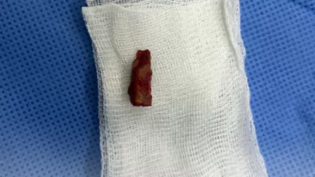 С куском ветки в голове несколько лет жил 10-летний павлодарец 