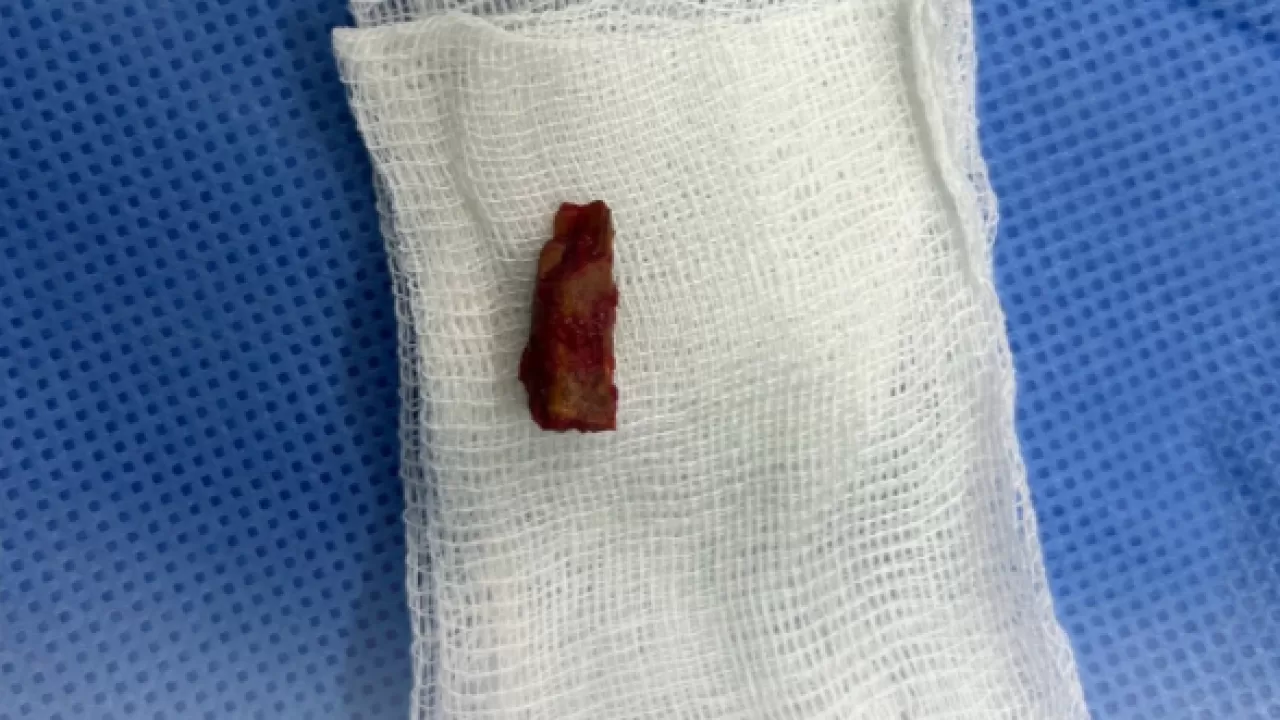 С куском ветки в голове несколько лет жил 10-летний павлодарец 