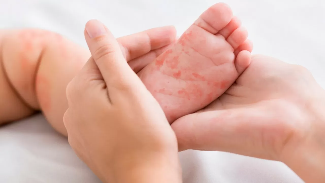 Эпидемия кори в Астане: почти 500 детей пролечились в стационаре 