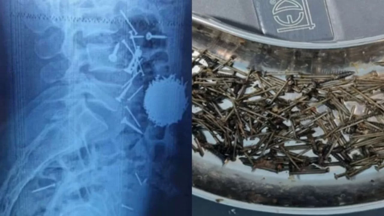 Өзбекстанда күйзелісте жүрген ер адам 200 грамм шеге жұтып қойған