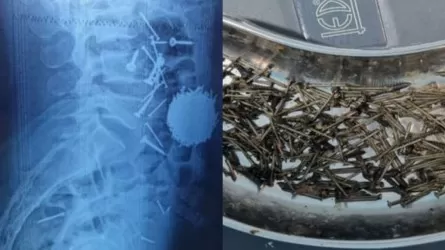 Өзбекстанда күйзелісте жүрген ер адам 200 грамм шеге жұтып қойған