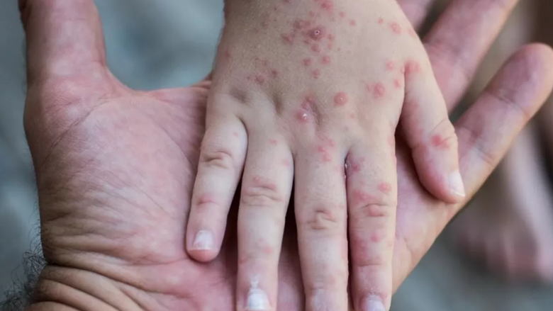 Өлімге әкелуі мүмкін инфекцияның таралуы Қазақстанда әлі де күрделі болып тұр