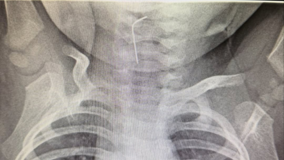 Түркістанда 9 айлық сәби ине жұтып қойды