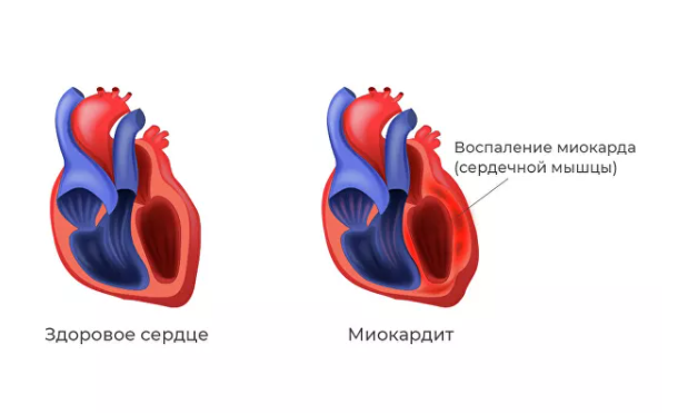 Выявили новое опасное осложнение после коронавируса